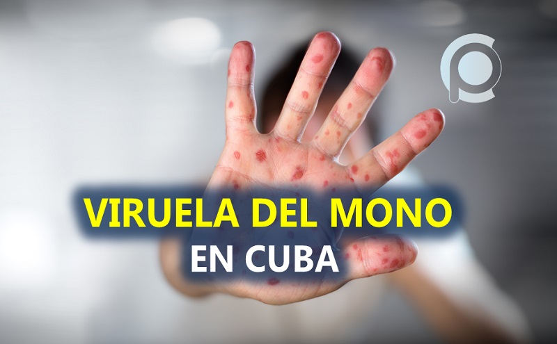 Viruela del mono en Cuba, lo que sabemos hasta el momento